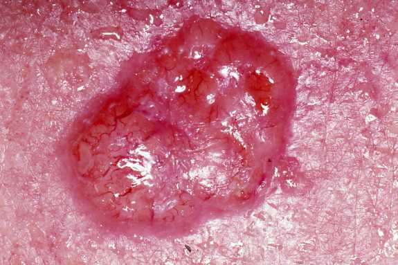 Basal_cell_carcinoma